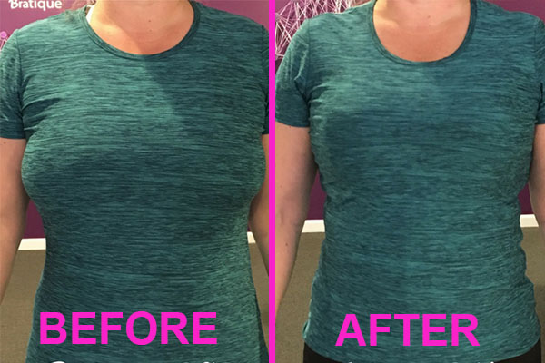minimizer bra before and after
