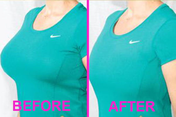 best minimizer bra before and after
